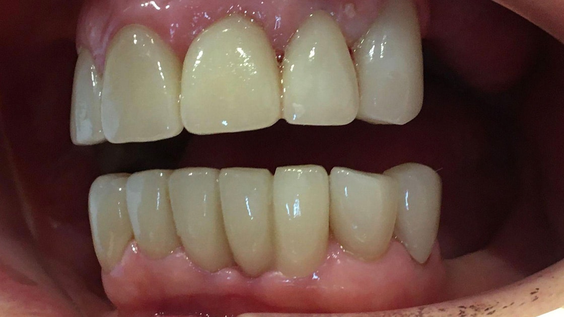 Veneers A1