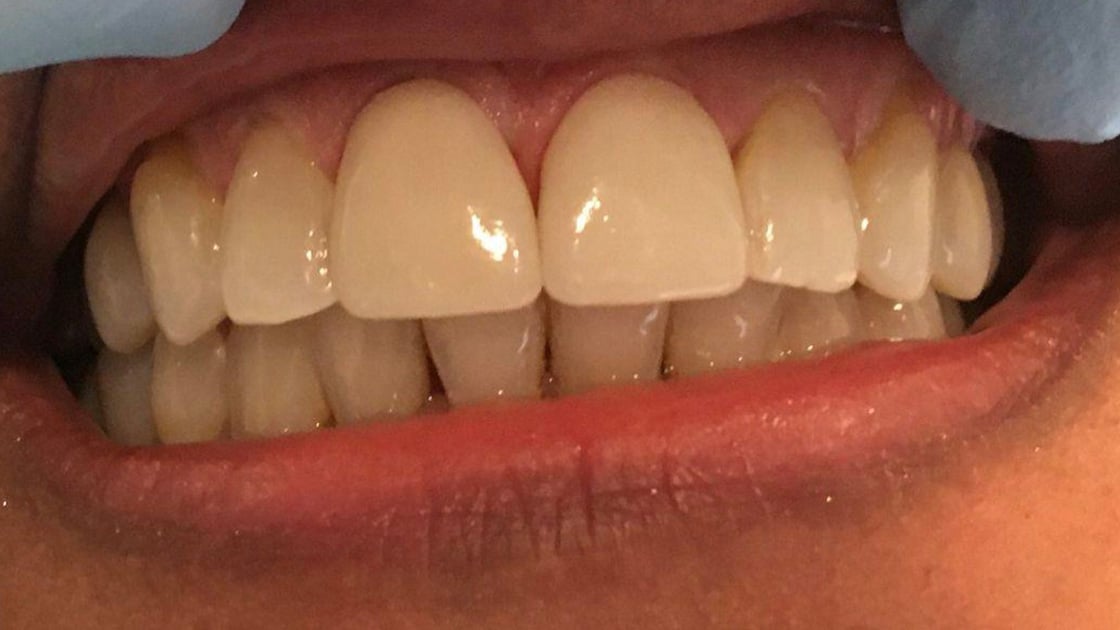 Veneers A2