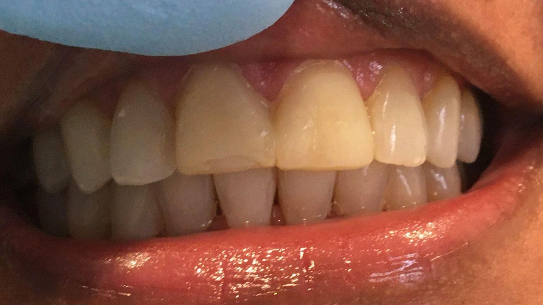 Veneers B2